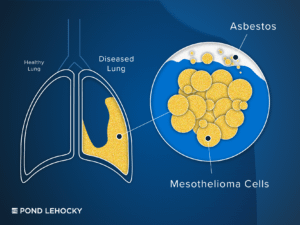 Free Mesothelioma Case Evaluation