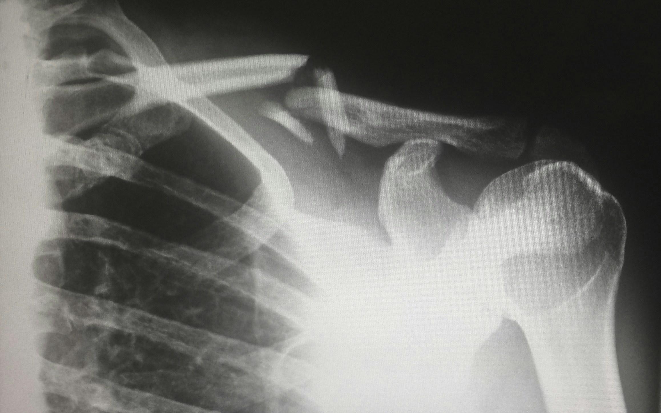An X-ray image showing a severely fractured clavicle, with multiple displaced bone fragments near the shoulder and upper rib area.